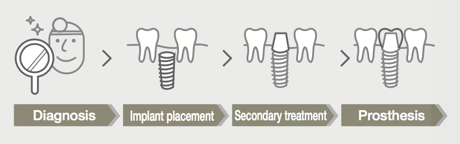 Dental Implants In Luton